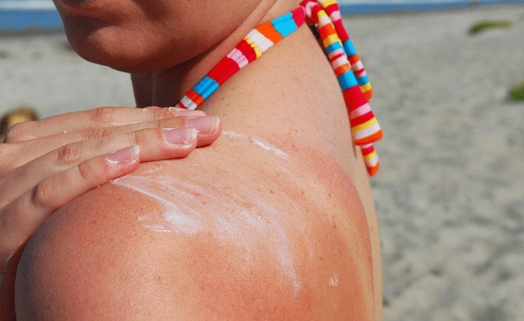 girl with sunburn